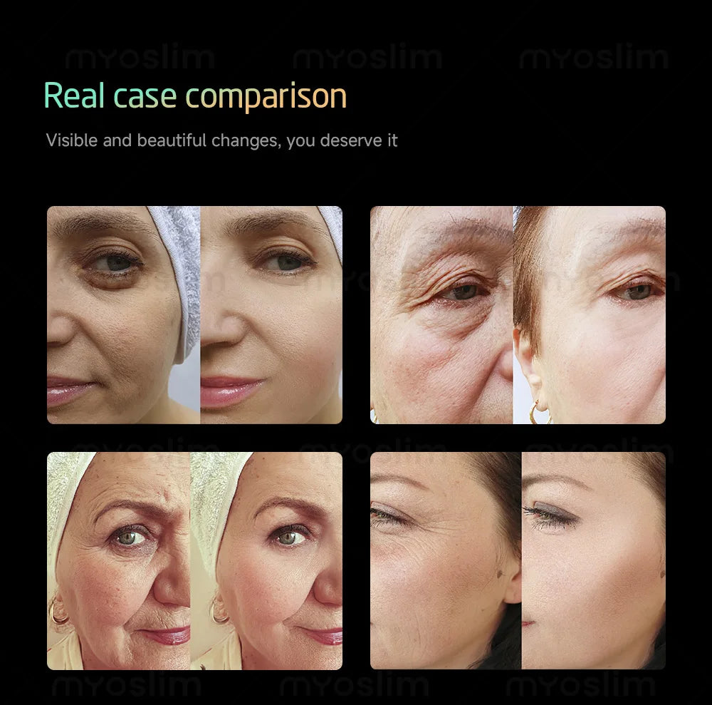 25D HIFU 360MAX - Professional Face Lifting & Body Sculpting Machine