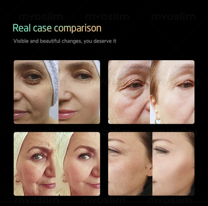 25D HIFU 360MAX - Professional Face Lifting & Body Sculpting Machine